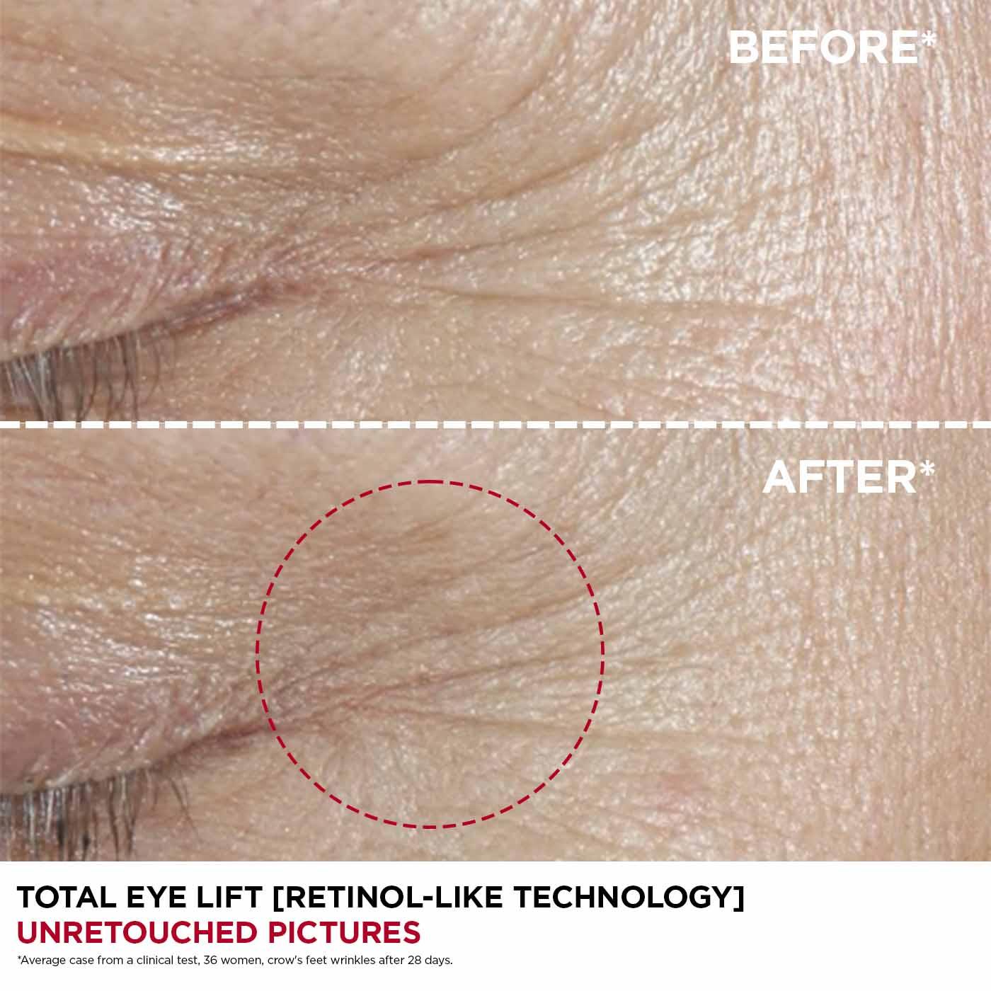 לפני ואחרי טיפול עיניים Total Eye Lift, הפחתת קמטים בעור, מבית CHOZEN קבוצת אלפא
