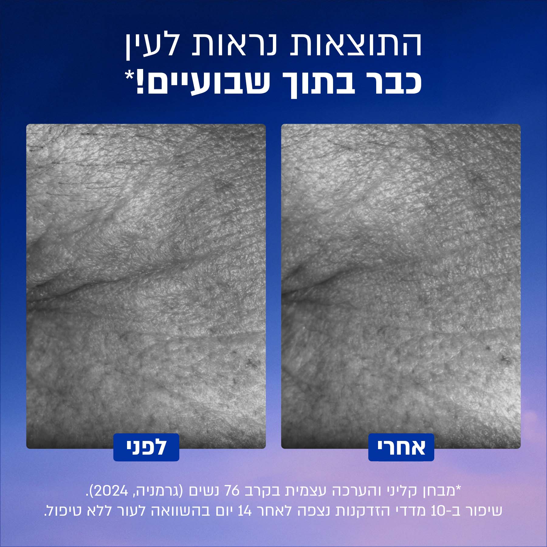 השוואה של עור לפני ואחרי טיפול להפחתת קמטים, תוצאה תוך שבועיים