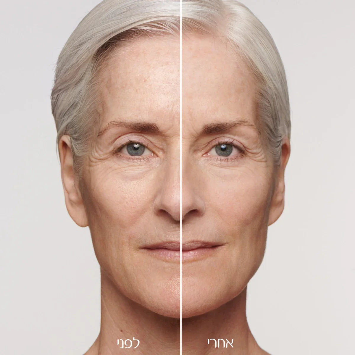 לפני ואחרי טיפול אנטי אייג'ינג, תוצאה משופרת לעור הפנים, CHOZEN אלפא מותגים מובילים